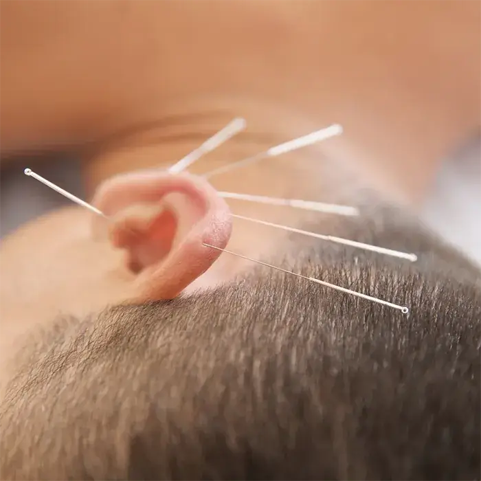 Ohrakupunktur Naturheilpraxis Gransch Ohrakupunktur mit mehreren feinen Nadeln am Ohr