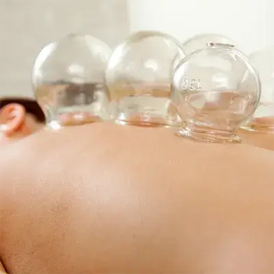 Schröpfen Naturheilpraxis Gransch Schröpfgläser auf dem Rücken bei einer Schröpfbehandlung